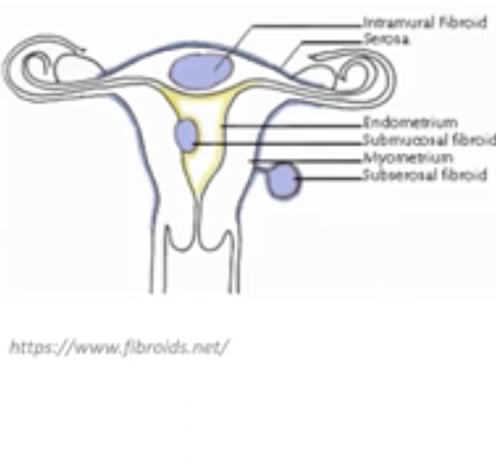 <ul><li><p>No histology because there is no atypia or mitosis or necrosis</p></li><li><p>Infertility or pain (in the case of an ischemia)</p></li></ul>