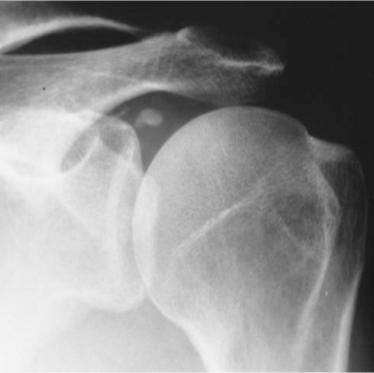 <p>Hydroxyapatite deposition disease (HADD) of the _____</p>