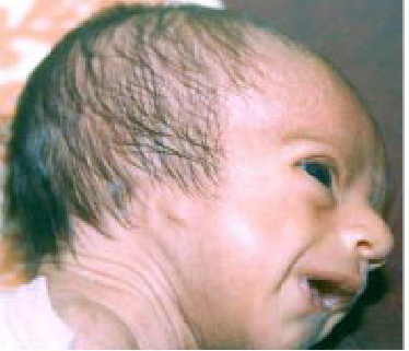 <p>absent pina</p><p><span style="background-color: transparent;">Congenital (present at birth); may be associated with a syndrome</span></p><p><span style="background-color: transparent;">Treatment: Possible surgical reconstruction; amplification if indicated</span></p>