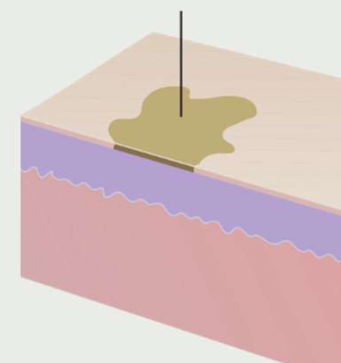 <p>¿lesión?</p><p>¿primaria o secundaria?</p>