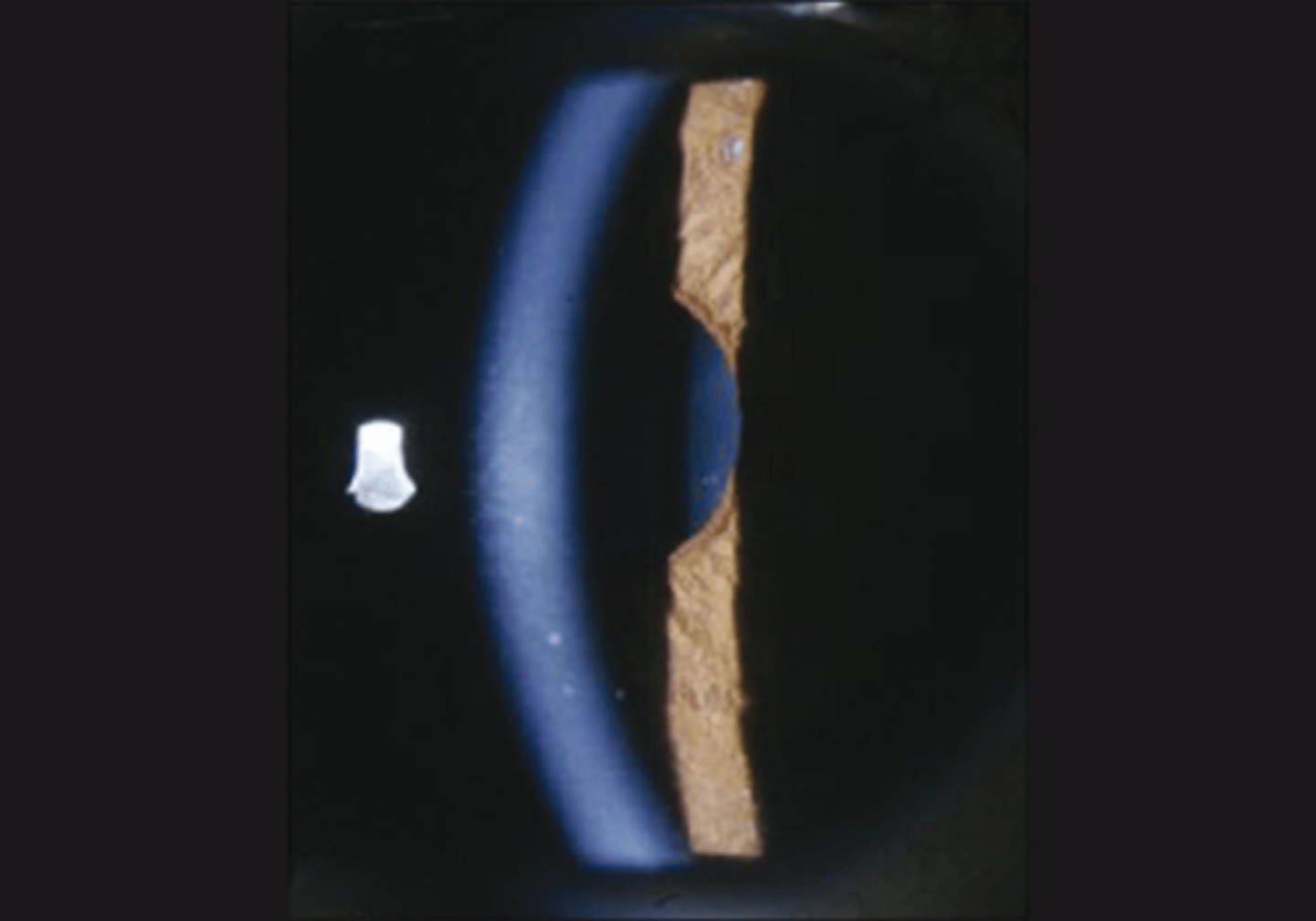 <p>sector paralysis = abnormal shape due to sphincter/dilater paralysis</p><p>stromal spread = iris stroma spreads due to lack of innervation</p><p>pigment stream entropion = pupil border of iris is entropic adjacent to a part of the pupil border that is more flat</p><p>stromal streaming = stroma flows towards area that sphincter still works when light is turned on</p>