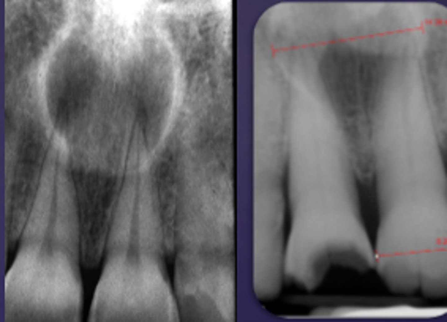 <p>ID the cyst:</p><p>- Lesion is superimposed over the apices of maxillary central incisors</p><p>- No changes in apical structures of these teeth (lamina dura, PDL)</p><p>- Vital teeth</p><p>- May displace these teeth</p>
