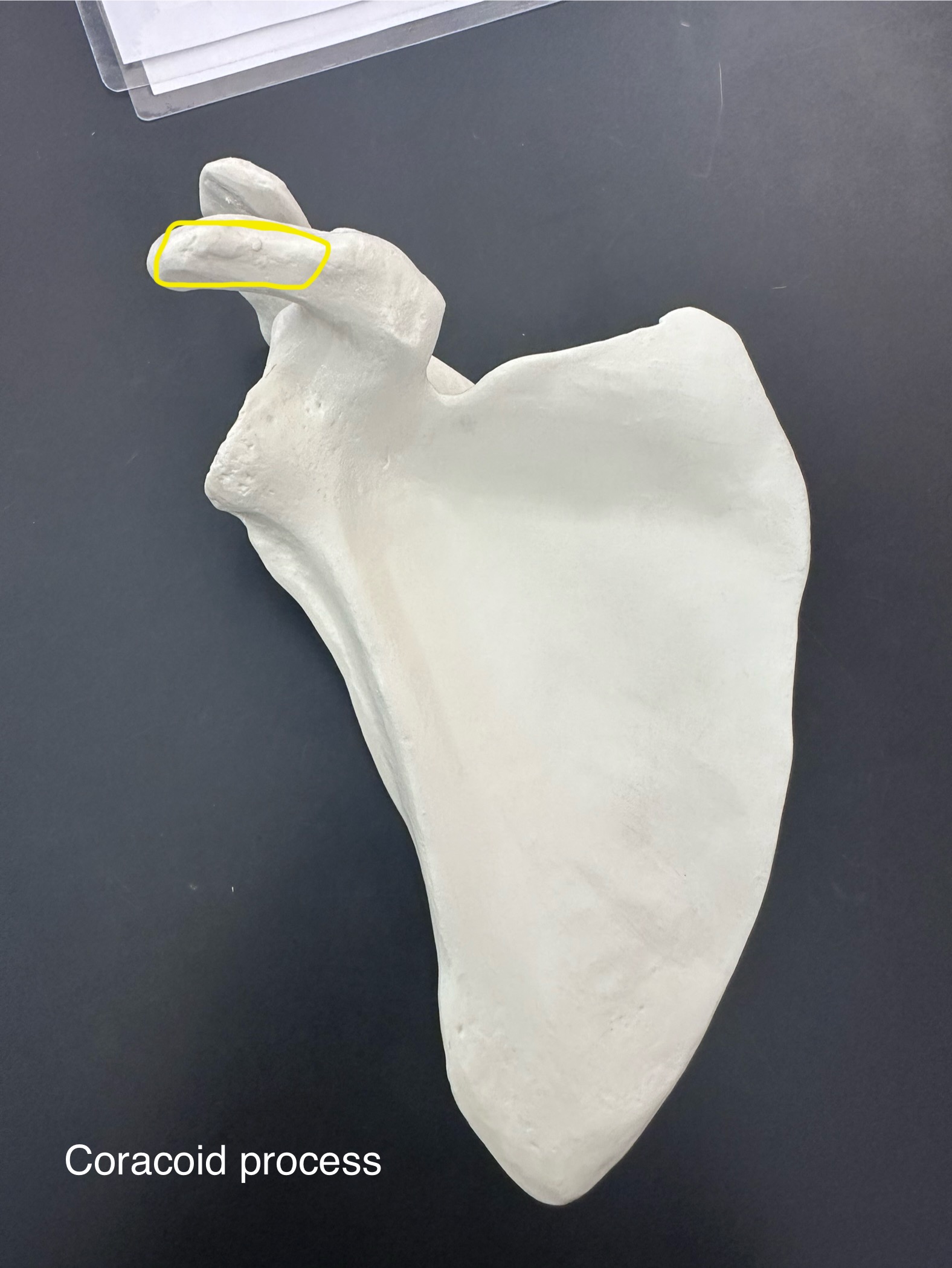 <p>Coracoid Process of scapula</p>