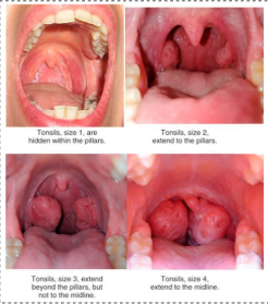 <p>0 = no tonsils (due to past tonsillectomy) </p><p>1 = hidden behinds the pillars, barely visible</p><p>2 = extend to the pillars, visible and normal size </p><p>3 = extends beyond the pillars but they are not midline yet (enlarged, may partially obstruct airway) </p><p>4= midline, touching the uvula or each other (likely to cause airway obstruction, breathing and swallowing issues) </p>