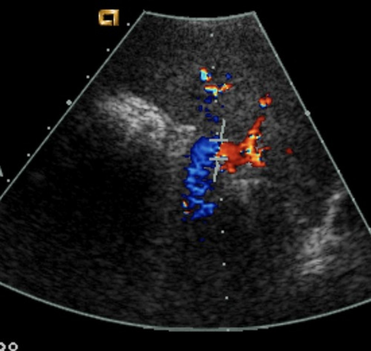 <p>Splenic vein: blue</p>