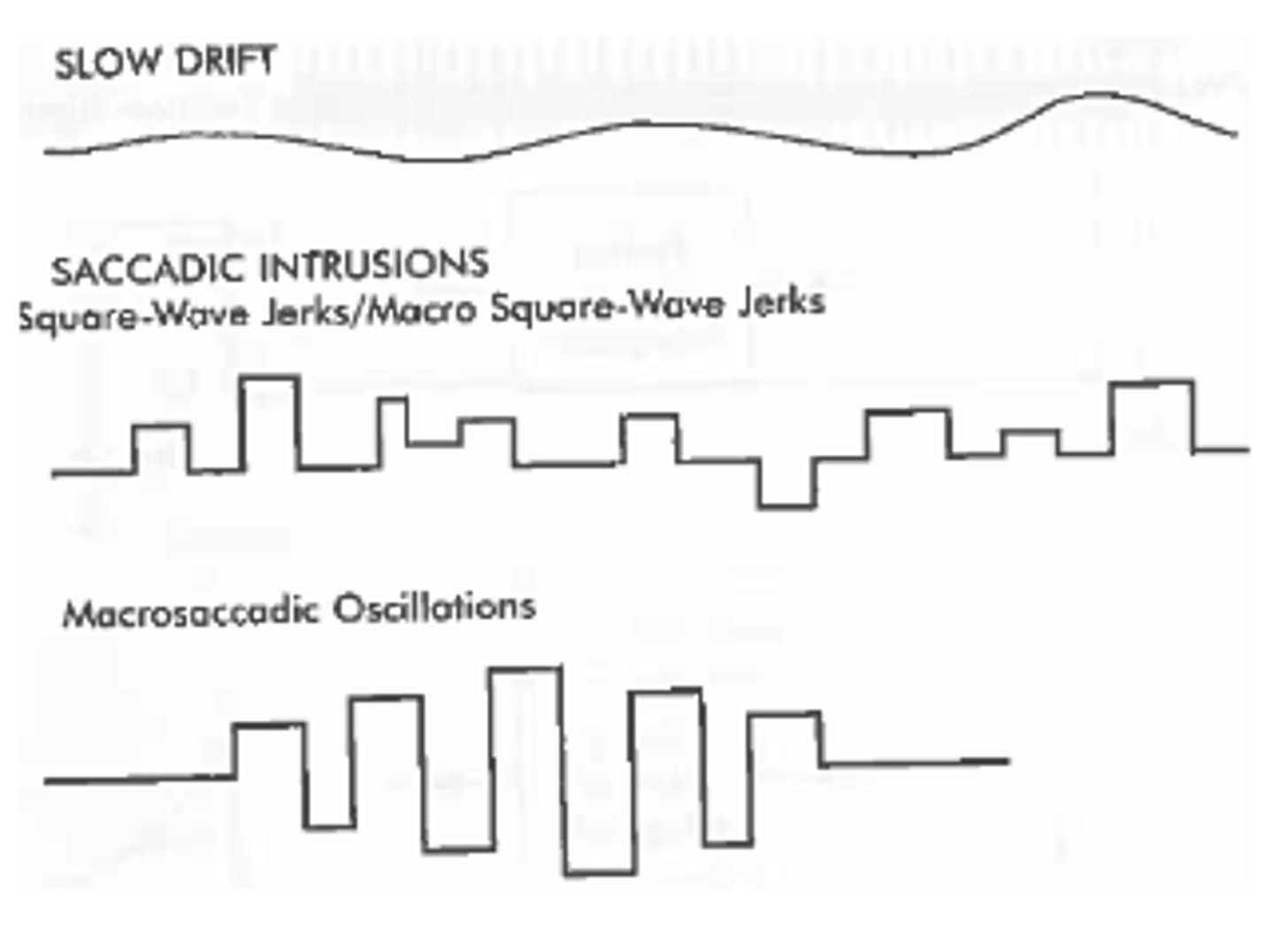 <p>1. square-wave jerk</p><p>2. macro square-wave jerk</p><p>3. macrosaccadic oscillation</p>