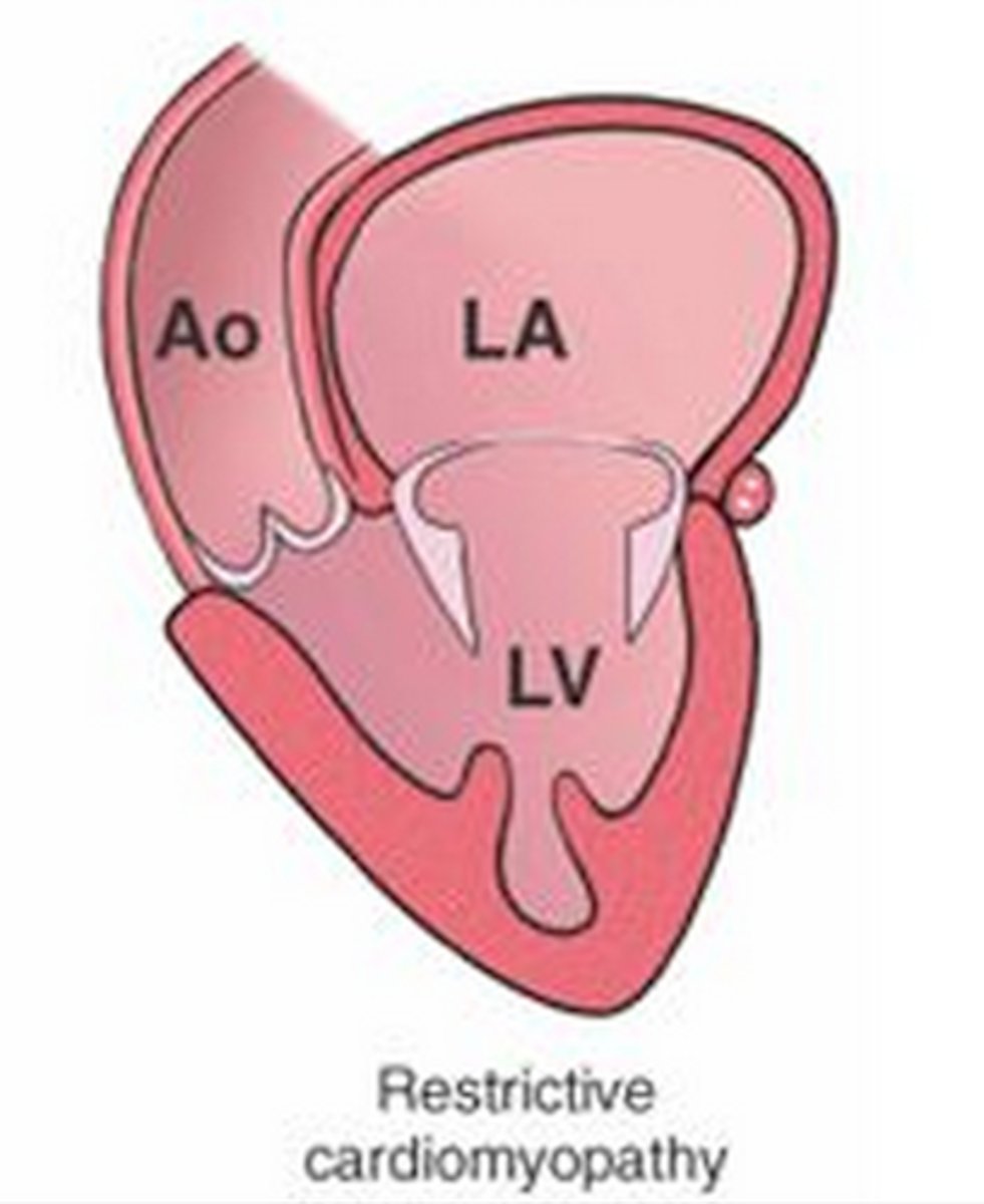 <p>myocardium becomes rigid and noncompliant, impeded ventricular filling and raising filling pressures during diastole</p>
