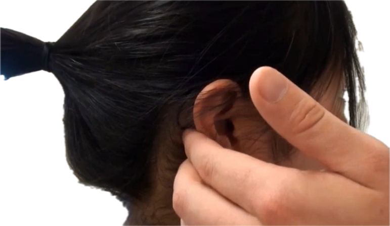 <p>Postauricular (behind ear - both sides)</p>