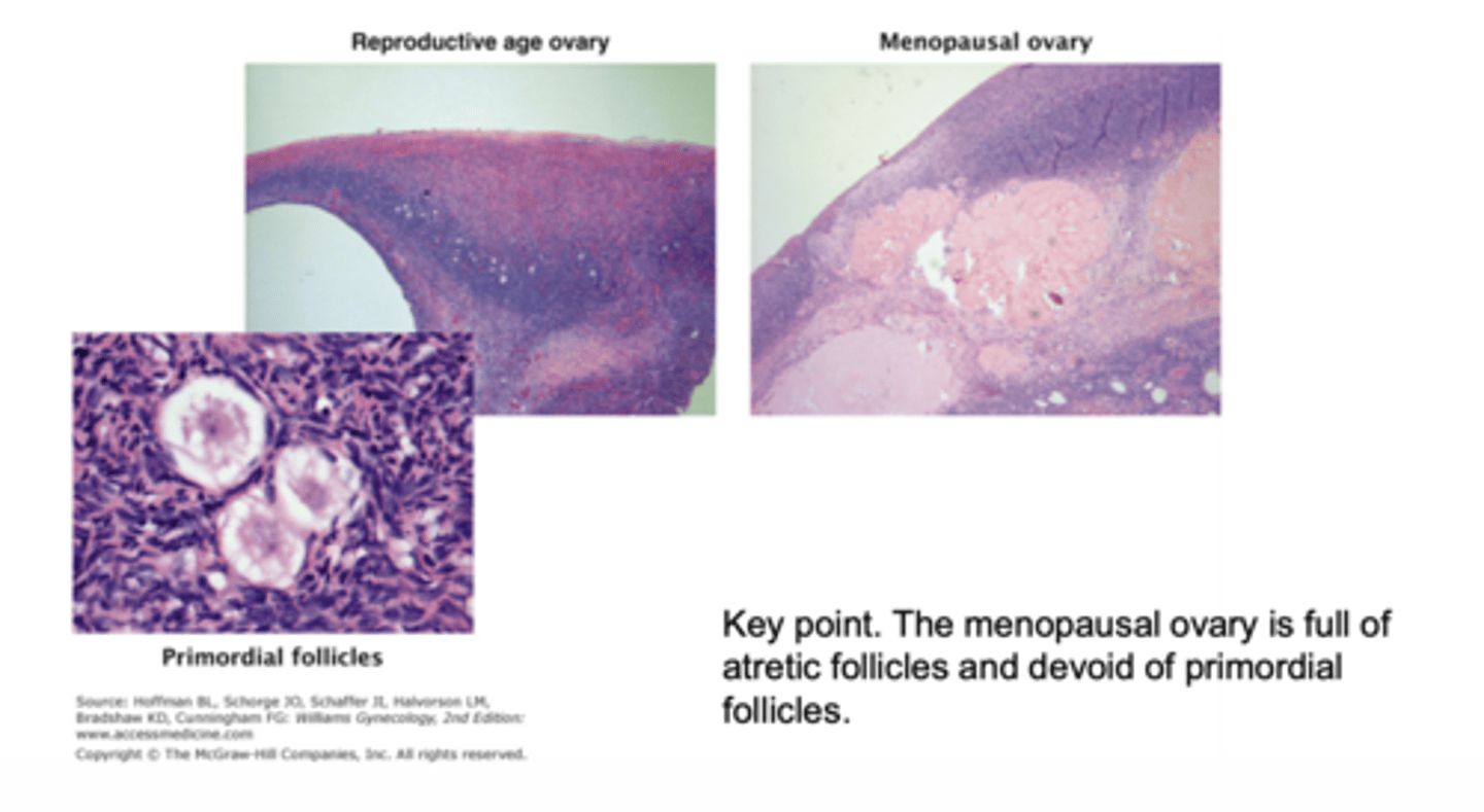 <p>atretic follicles with loss of primordial follicles</p>