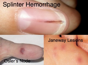 <ul><li><p>Splinter hemorrhages</p><ul><li><p><u>Linear nailbed bleeding</u> (septic microemboli or immune complexes (vasculitis))</p></li></ul></li></ul><ul><li><p>Osler nodes</p><ul><li><p><u>Tender, palpable nodules</u> on <span style="font-size: inherit">finger pulps or thenar/hypothenar eminences</span> (septic microemboli or immune complexes (vasculitis))</p></li></ul></li></ul><ul><li><p>Janeway lesions</p><ul><li><p><u>Non-tender lesions</u> on palms or finger pulps (septic microemboli)</p></li></ul></li></ul><p></p>