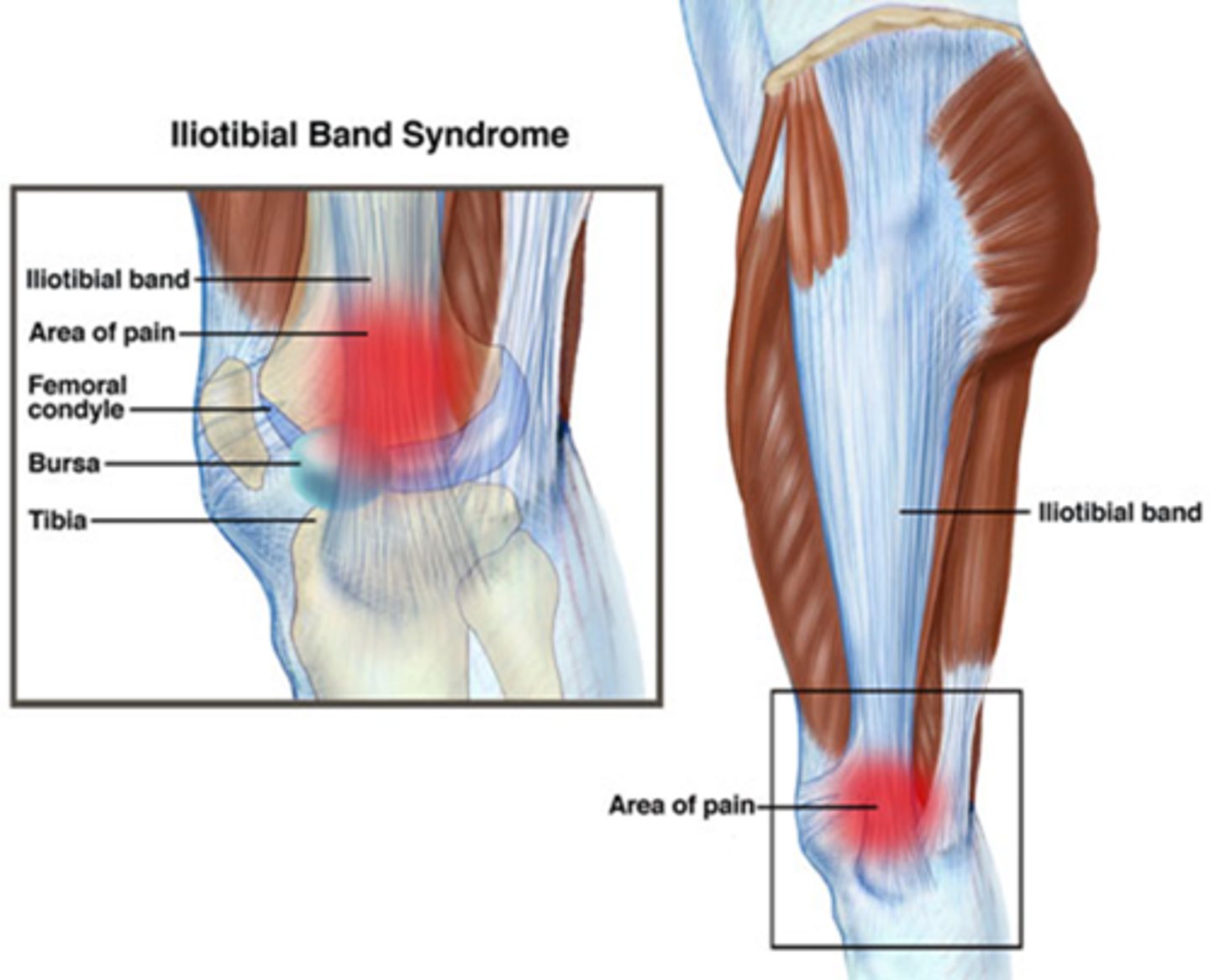 <p>Age 25-55; MOI- overuse</p><p>Pain with repetitive movements, climbing or descending stairs</p><p>Lateral knee pain diffuse & hard to localize</p><p>Localized tenderness at lateral femoral condyle.</p>