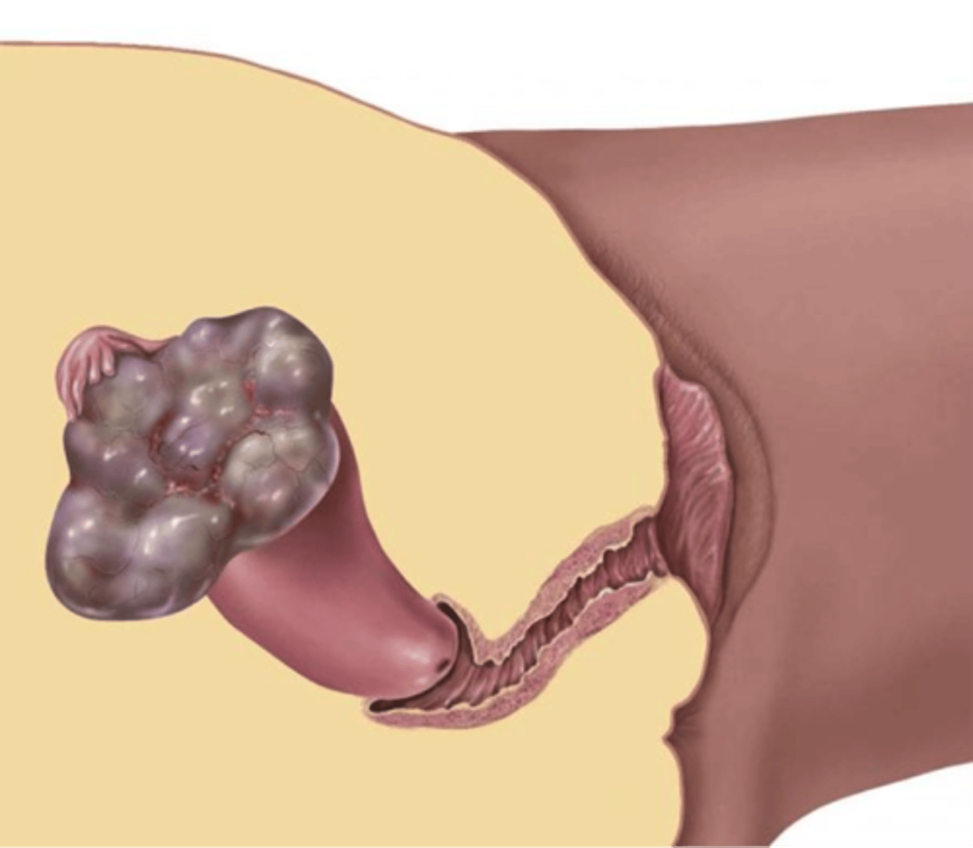 <p>malignant tumor of the ovary</p>