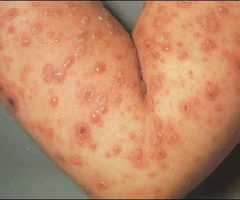 <p>1-2 days before lesions appear until all lesions have formed crusts</p>