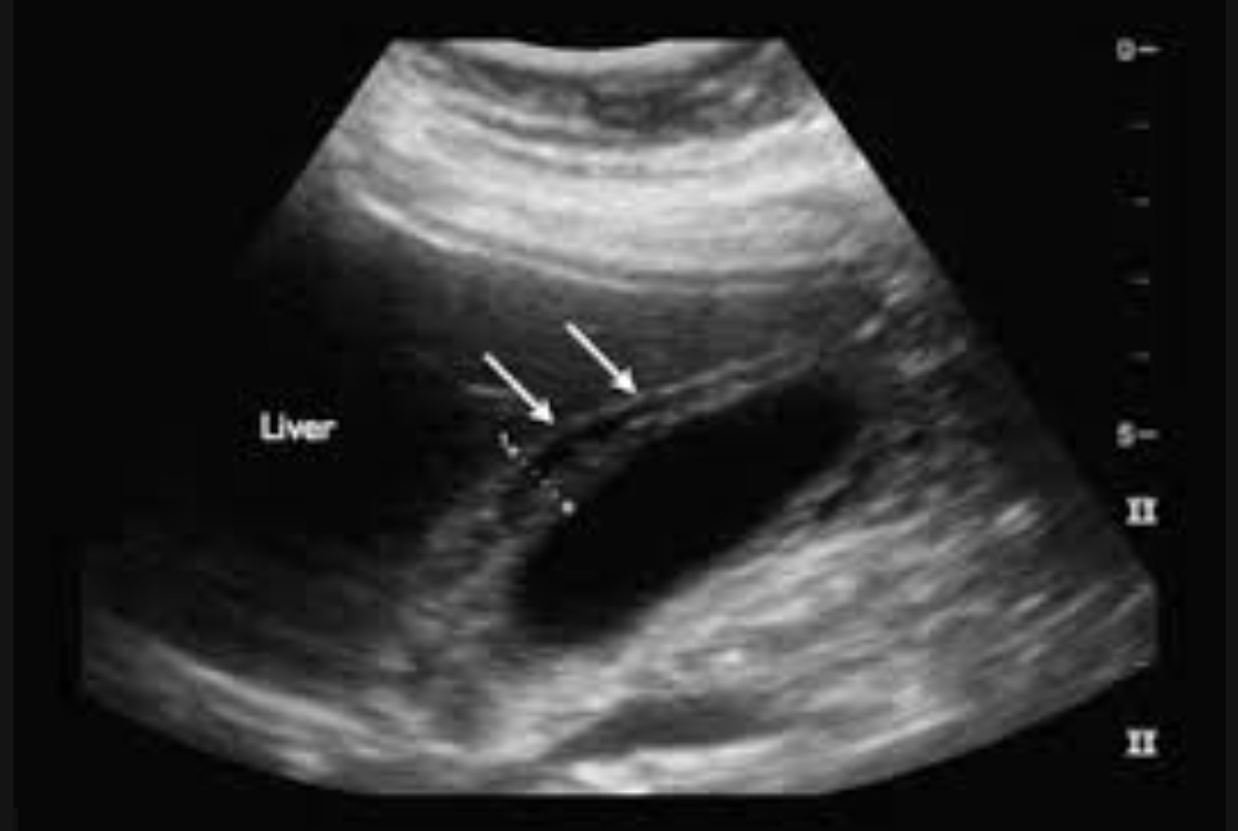 <p>A<span>cute inflammation without stones; seen in critically ill, trauma, burns</span></p><p><span>Wall thickening &gt;3.5mm </span></p><p>E<span>nlarged GB, wall thickening, sludge, pericholecystic fluid, positive Murphy’s sign, no stones </span></p>