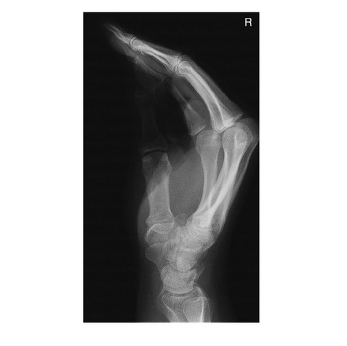 <p>a. Lateral Flexion</p>