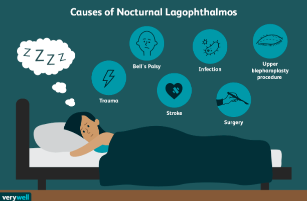 <ul><li><p>sleeping w/ eyes open</p></li><li><p>causes →</p></li></ul><p></p>