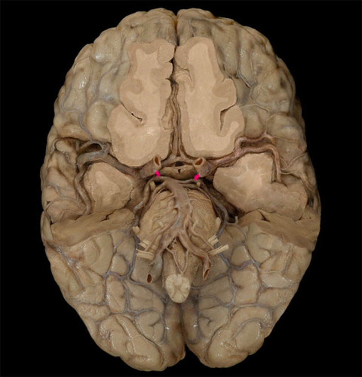 <p>-comes off posterior cerebral arteries</p><p>-anteriorly to internal carotid</p>