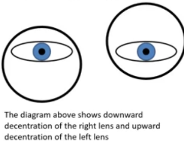<p>for higher prescriptions, tilt of a spectacle frame can induce significant amounts of unwanted prism, leading to vertical diplopia </p><p></p>