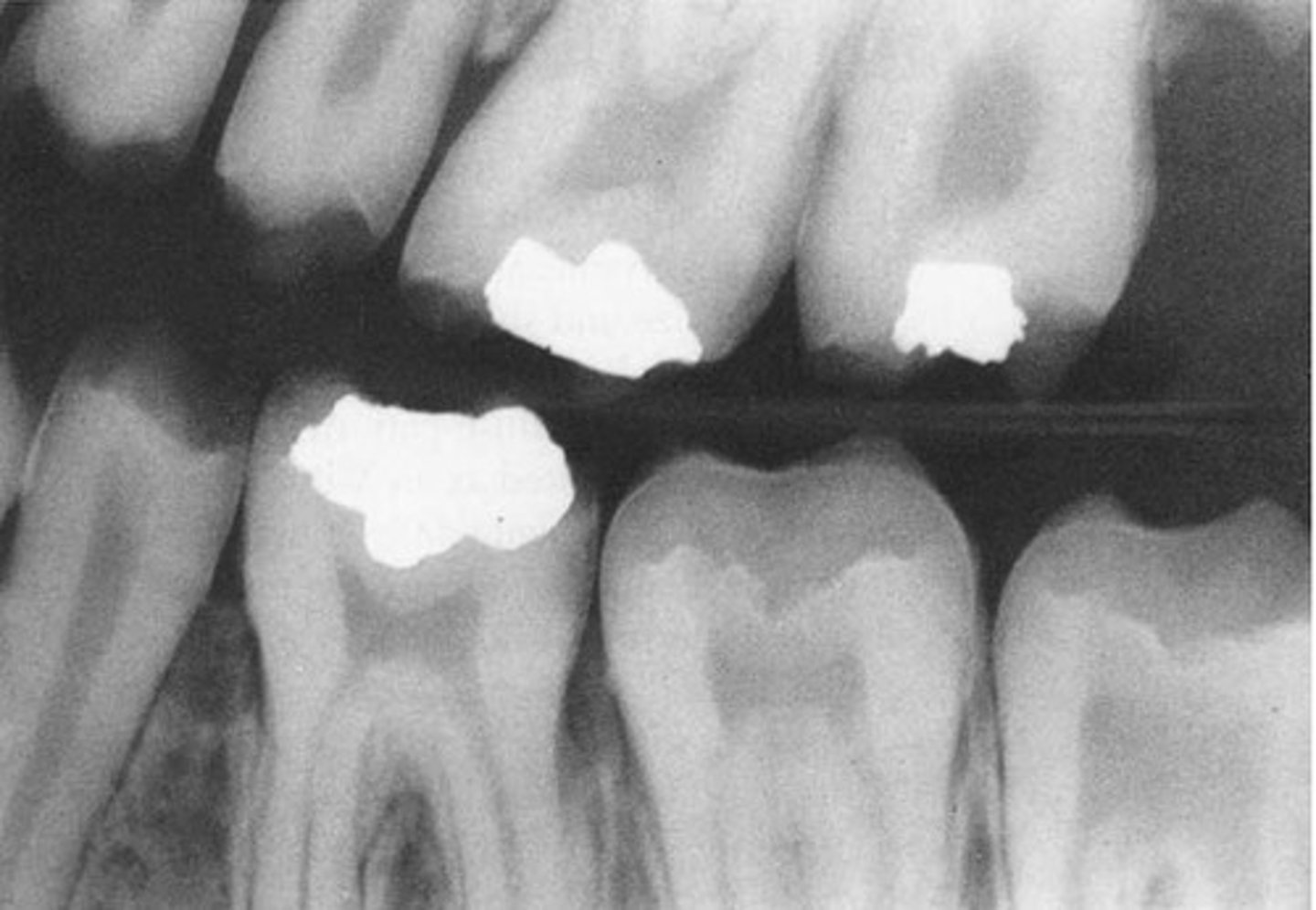<p>-affects primary and permanent dentitions = all teeth</p><p>-on XR → normal dentin/normal pulp/abnormal enamel</p>
