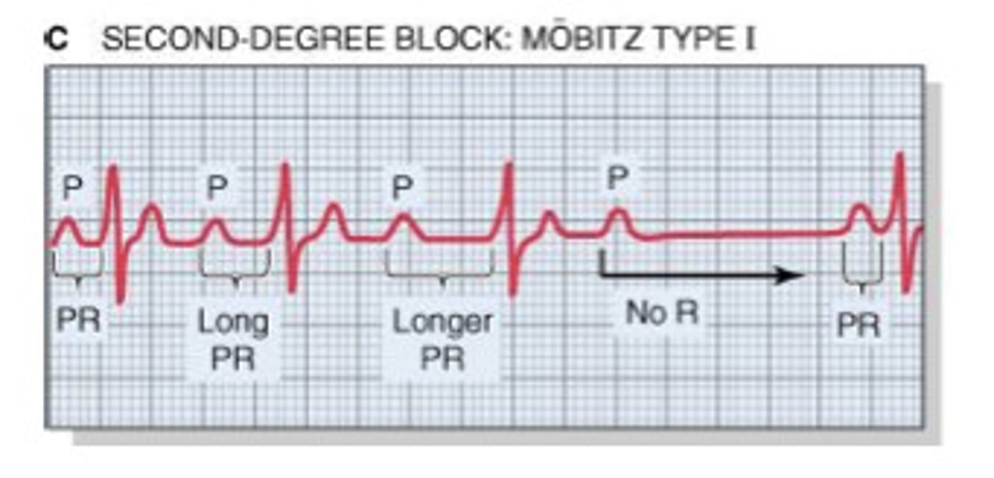 <p>1) Progressive increase of the PR interval</p><p>2) Progressive shortening of the R-R interval</p><p>3) Dropped QRS</p><p>Common with acute inferior wall MI</p>