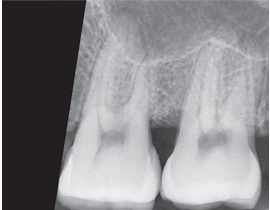 <p>How would you resolve this FIXER CUT-OFF X-ray?</p>