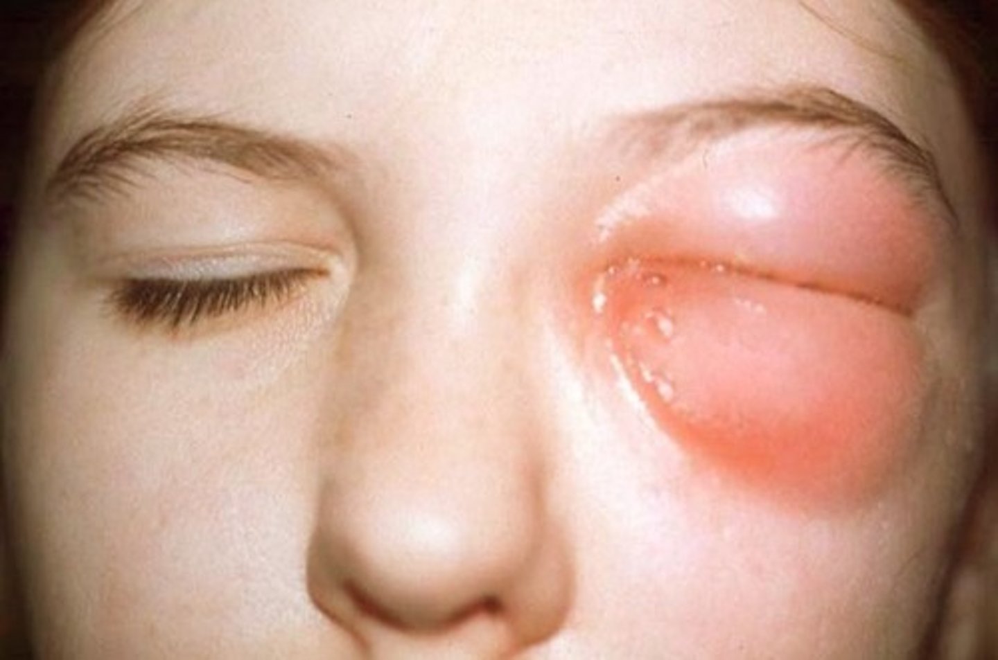 <p>Spread of infection from sinuses to the orbit/brain → could lead to vision loss, brain infection, possibly fatal.</p><p>- Often occurs due to sinusitis due to the thin walls of sinus cavities</p>