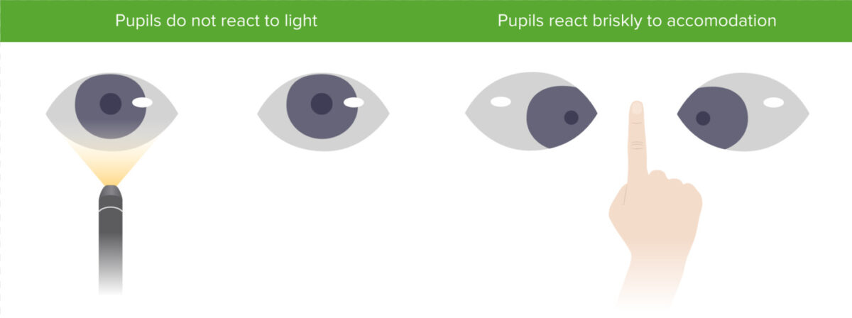 <p>= occurs w CNS syphilis, brain tumors, meningitis, alcoholism, drugs, DM</p><ul><li><p>small &amp; mishappen pupils that do not react to light but can accommodate</p></li></ul>