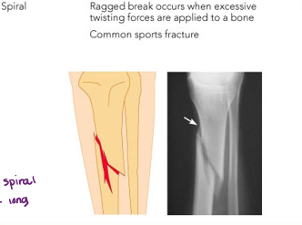 <p>ragged break that occurs when excessive twisting forces are applied to the bone </p>