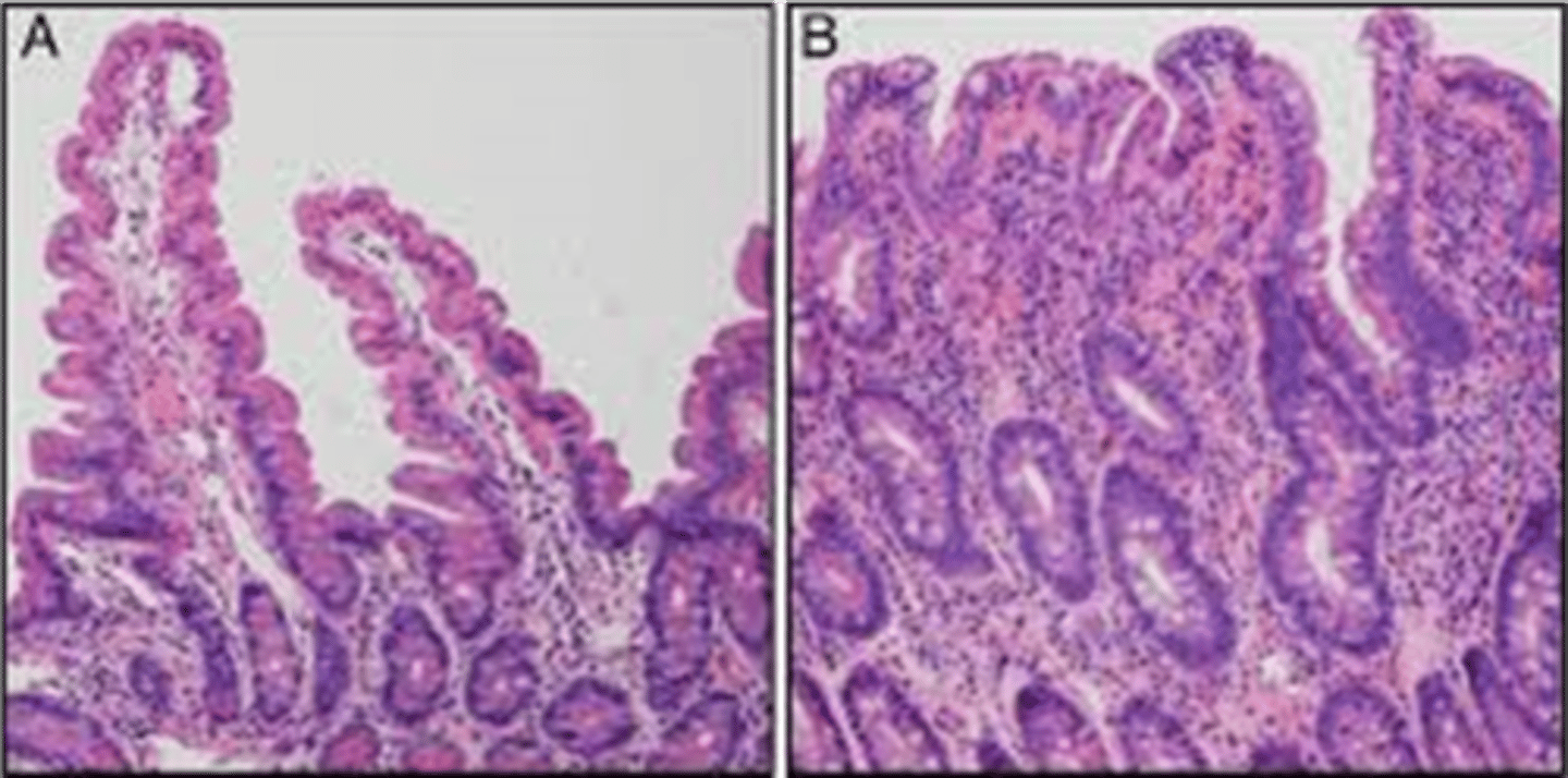 <p>Define Condition:</p><p>Immune-mediated inflammatory disease of the small intestine caused by sensitivity to dietary gluten and related proteins</p><p>-Hx: A/w...</p><p>&gt; Down's Syndrome</p><p>&gt; Type 1 DM</p><p>-Path: Allergy to gluten (BROW = Barley, Rye, Oats, Wheat)</p><p>-Sx:</p><p>&gt; Diarrhea (Bulky, foul smelling, floating = Steatorrhea)</p><p>&gt; Flatulence</p><p>&gt; Malabsorption:</p><p>&gt;&gt; Wt Loss</p><p>&gt;&gt; Severe Anemia</p><p>&gt;&gt; Neuro Sx (Vit B9/B12)</p><p>&gt;&gt; Osteopenia (Ca/Vit D)</p><p>&gt; Oral Ulcers</p><p>&gt; ALCs</p><p>&gt; Rash</p><p>-Dx:</p><p>&gt; CONFIRM = GLUTEN CHALLENGE + Upper Endoscopy/Bx</p><p>&gt; Biopsy: FLATTENED VILLI</p><p>&gt; Endoscopy:</p><p>&gt;&gt; Blunted villi</p><p>&gt;&gt; Crypted hyperplasia</p><p>&gt;&gt; Lymphocytic infiltrate of crypts</p><p>&gt; Labs:</p><p>&gt;&gt; IDA</p><p>&gt;&gt; Electrolyte imbalance</p><p>&gt;&gt; Vit Deficiency (ADEK)</p><p>&gt; Serology:</p><p>&gt;&gt; IgA endomysial</p><p>&gt;&gt; Anti-tTG Ab</p><p>&gt;&gt; HLA-DQ2/DQ8</p><p>-Tx:</p><p>&gt; Exclude gluten</p><p>&gt; DEXA Scan + Appropriate Tx</p><p>&gt; Tx Anemia</p>