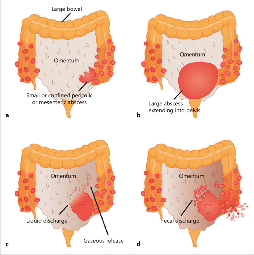 <p><span><span>Classification to grade the severity of </span></span><strong>acute diverticulitis</strong></p><ul><li><p>Stage 0</p><ul><li><p>thickened bowel wall</p></li></ul></li><li><p>Stage 1a</p><ul><li><p>Periocolic mesenteric infiltration</p></li></ul></li><li><p>Stage 1b</p><ul><li><p>Pericolic/ mesocolic small <4cm abscess</p></li></ul></li><li><p>Stage 2a</p><ul><li><p>Larger abscesses without free air, often confined to pelvis</p></li></ul></li><li><p>Stage2b</p><ul><li><p>with free air</p></li></ul></li><li><p>Stage 3</p><ul><li><p>Perforated diverticulitis</p></li><li><p>when peridiverticular abscess has suptured in <strong><u>purulent peritonitis</u></strong></p></li></ul></li><li><p>Stage 4</p><ul><li><p>Ruture of uninflamed and unobstructed diverticulum into free peritoneal cavity with <strong><u>fecal contamination- free rupture</u></strong></p></li></ul></li></ul><p></p>