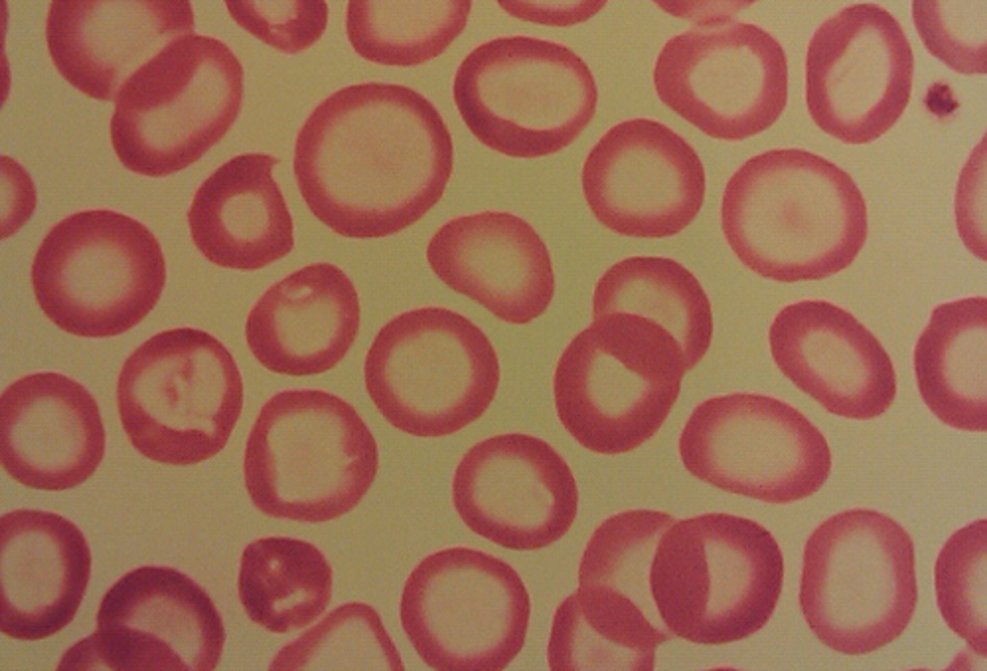 <p>(cell color)</p><p>decreased pigment (increased pallor)</p>