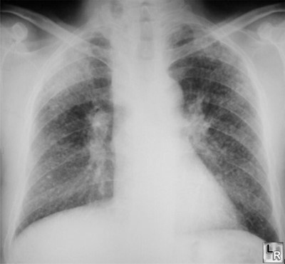 <p>Silicosis</p>