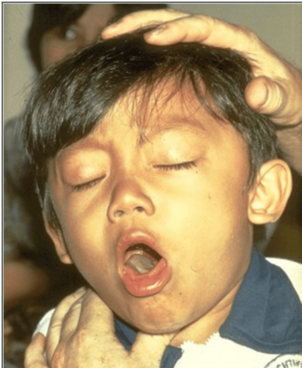 <p>highly contagious bacterial infection of the respiratory tract characterized by an acute crowing inspiration, or whoop (also called whooping cough)</p>
