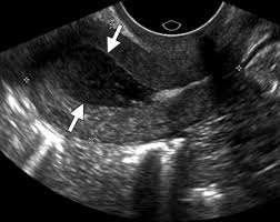<ul><li><p>caused by </p><ul><li><p>radiation</p></li><li><p>surgery</p></li><li><p>infection</p></li><li><p>menopause</p></li></ul></li><li><p>post meno - hydro/hemato/pyo metra</p></li><li><p>pre meno - inferility, cramps, irregular or no period</p></li></ul><p></p>