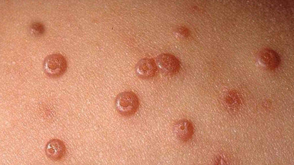 <p>what type of lesion and condition is depicted</p>