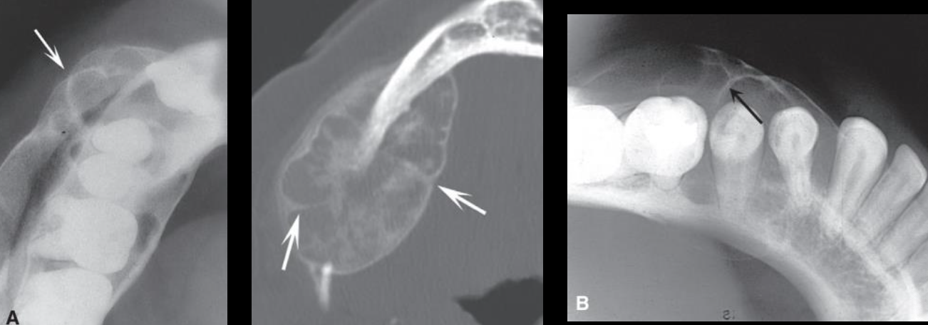 <p>Central Giant Cell Granuloma (CGCG)</p>