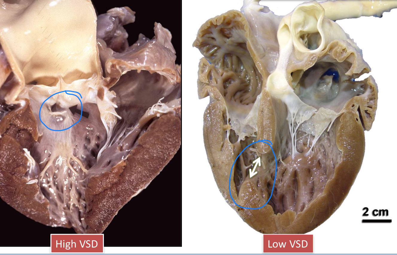 <p>A VSD is when the wall/septum that separates the ventricles does not form properly, resulting in communication between the LV and RV</p><p></p><ol><li><p>High VSD</p><ol><li><p>Defect in the <u>upper membranous portion</u> of the interventricular septum</p></li></ol></li><li><p>Low VSD</p><ol><li><p>Defect in the <u>lower muscular portion</u> of the interventricular septum</p></li></ol></li></ol><p></p>