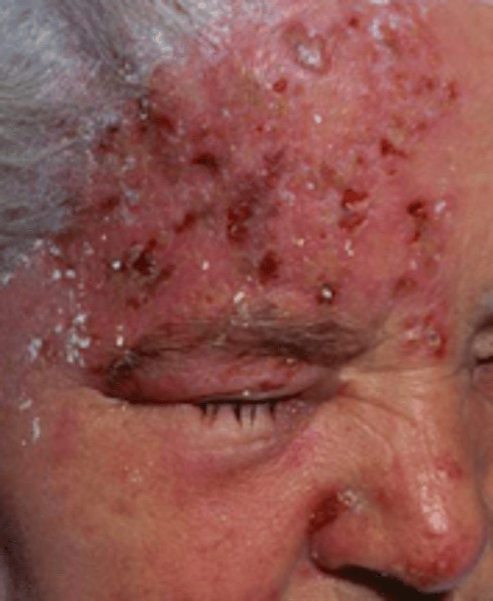 <p>Viral Skin Infections:</p><p>type of Herpes Zoster complication</p><p>- <strong>Hutchinson’s Sig</strong>n: vesicles on tip of nose. eye involvement</p><p>- always do <strong>fluorescein stain eye </strong>when zoster affects face</p><p>- <strong>can lead to blindness</strong></p><p>-<strong> REFER TO OPHTHALMOLOGY</strong></p>