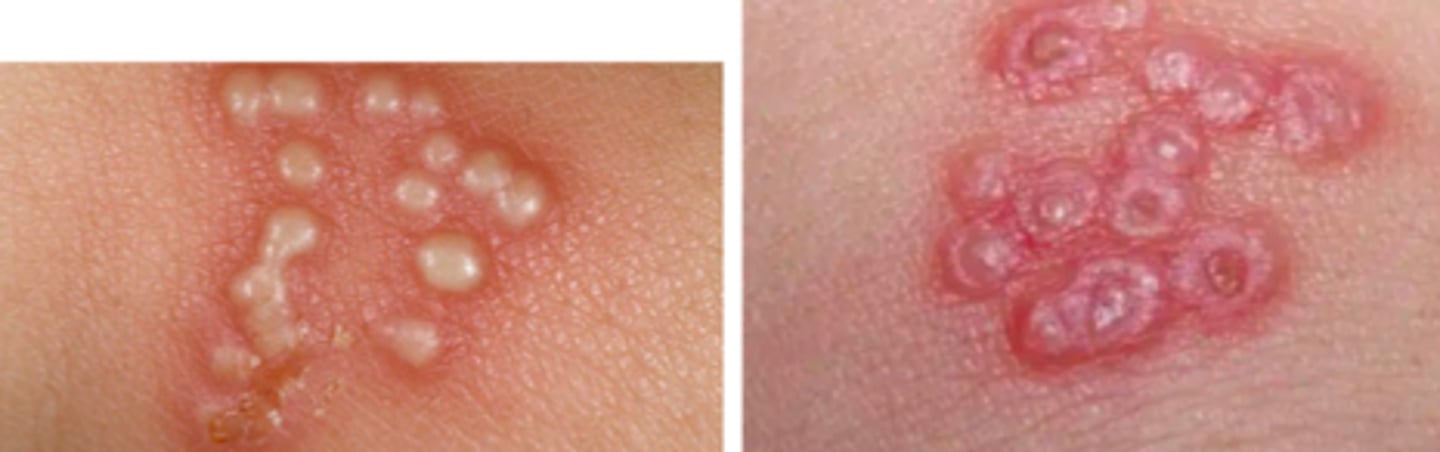 <p>Viral ID:</p><p>Subjective:</p><p>- Many are unaware of infection, so can pass it along without knowing</p><p>- Painful, recurring vesicles or ulcers; may begin with tingling, itching, or burning near where the sores will appear</p><p>- New infections may cause fever, body aches, swollen lymph nodes</p><p>Common Type I symptoms:</p><p>- Blisters (cold sores) or open sores (ulcers) in/around mouth or lips</p><p>Common Type II symptoms:</p><p>- Papules, vesicles, or ulcers around genitals or anus</p><p>- Lesions are painful; can break open, ooze, then crust over</p>