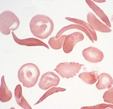 <p><span style="font-family: "Times New Roman", serif">Crescent- or sickle-shaped RBCs due to polymerization of hemoglobin S; hallmark of sickle cell disease.</span></p>