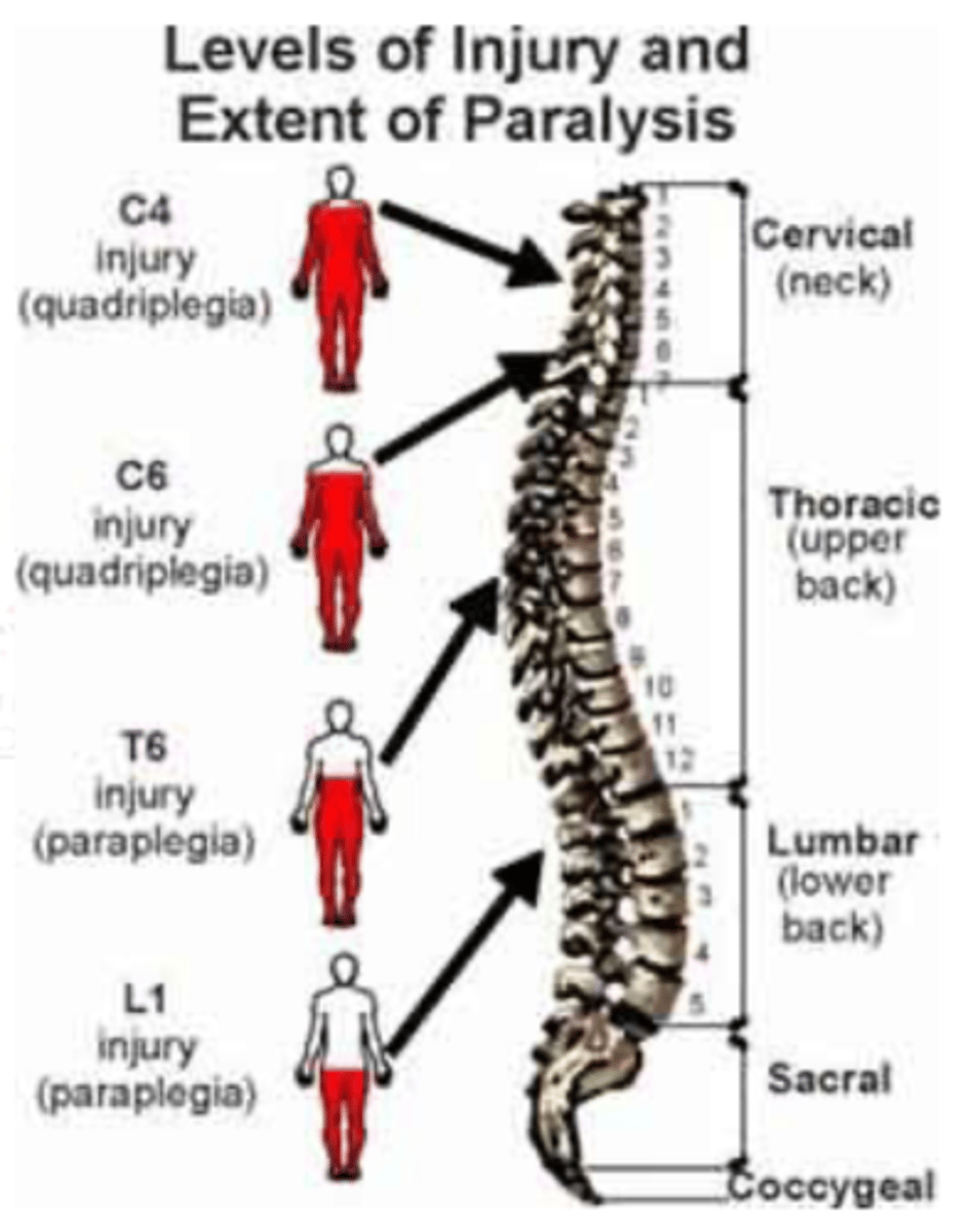 <p>Injury at C 3-5 or Higher</p><ul><li><p>Requires assistance mechanical ventilation to support breathing.</p></li><li><p>Loss of GI, walking, arm movement, breathing.</p></li><li><p>Quadriplegia</p></li></ul><p></p><p>Injury at C6</p><ul><li><p>Quadriplegia</p></li><li><p>Loss of GI function and walking</p></li></ul><p></p><p>Injury at T6</p><ul><li><p>Paraplegia</p></li><li><p>Loss of GI function and walking</p></li><li><p>May have shoulder movement</p></li></ul><p></p><p>Injury at L1</p><ul><li><p>Affects walking and bowel/bladder if complete injury</p></li><li><p>Paraplegia</p></li></ul><p></p>