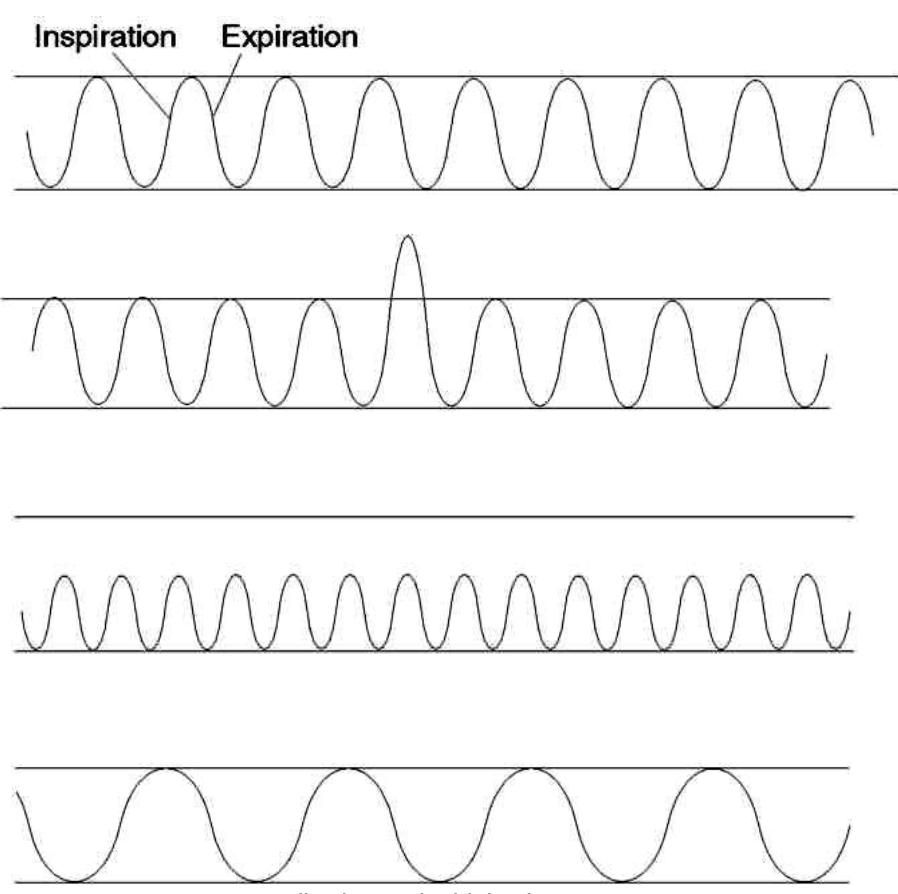 <ul><li><p>Normal Breathing, </p></li><li><p>Sigh, </p></li><li><p>Tachypnea (shallow breathing &gt;20/min), </p></li><li><p>Bradypnea (&lt;12/min, with or without a change in tidal volume), </p></li></ul><p></p>
