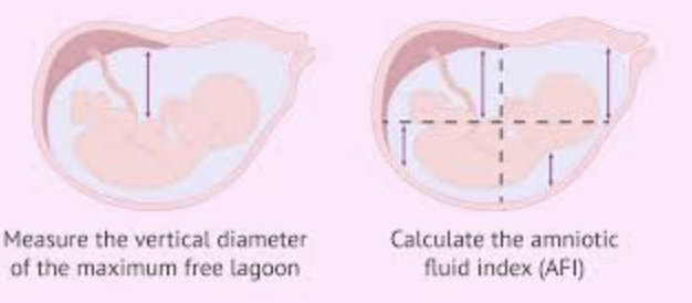 <p>vertical depths (in centimeters) of the largest pocket of amniotic fluid in all four quadrants surrounding the maternal umbilicus are totaled</p>