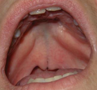<p>surface intact but defect exists in underlying musculature of sooft palate</p>