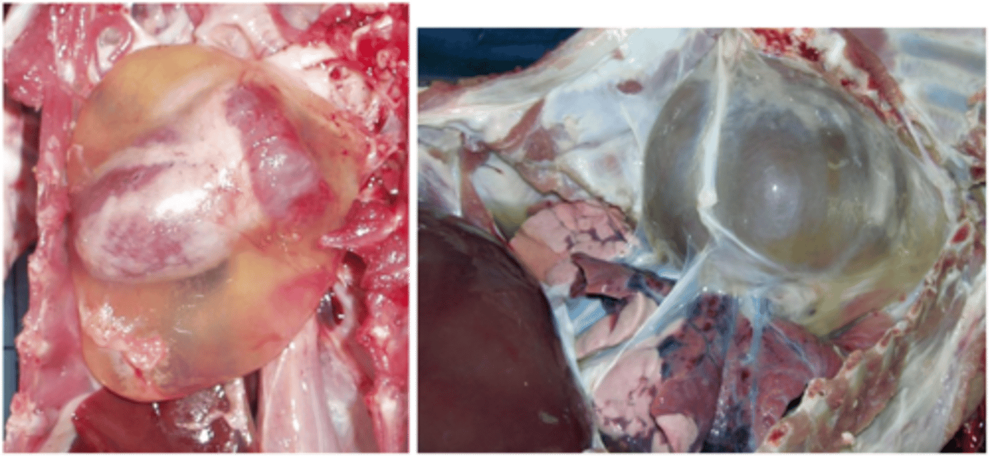 <p>Transudate in the pericardial sac</p>