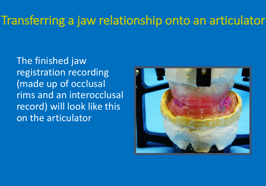 <ul><li><p>Finished jaw registration recording made up of occlusal rims and interocclusal record&nbsp;</p></li><li><p>“when you’ve done jaw reg, once trimmed rims to shape and restored natural tooth contacts, right amount of free way space you need to take final record which involves grooves in surface of rims and putting bite reg in lower arch to get patient to bite together - remind yourself which ICP or RCP</p></li><li><p>Grooves in the surfaces of the rims - get patient to bite together”</p></li><li><p></p></li></ul><p></p>