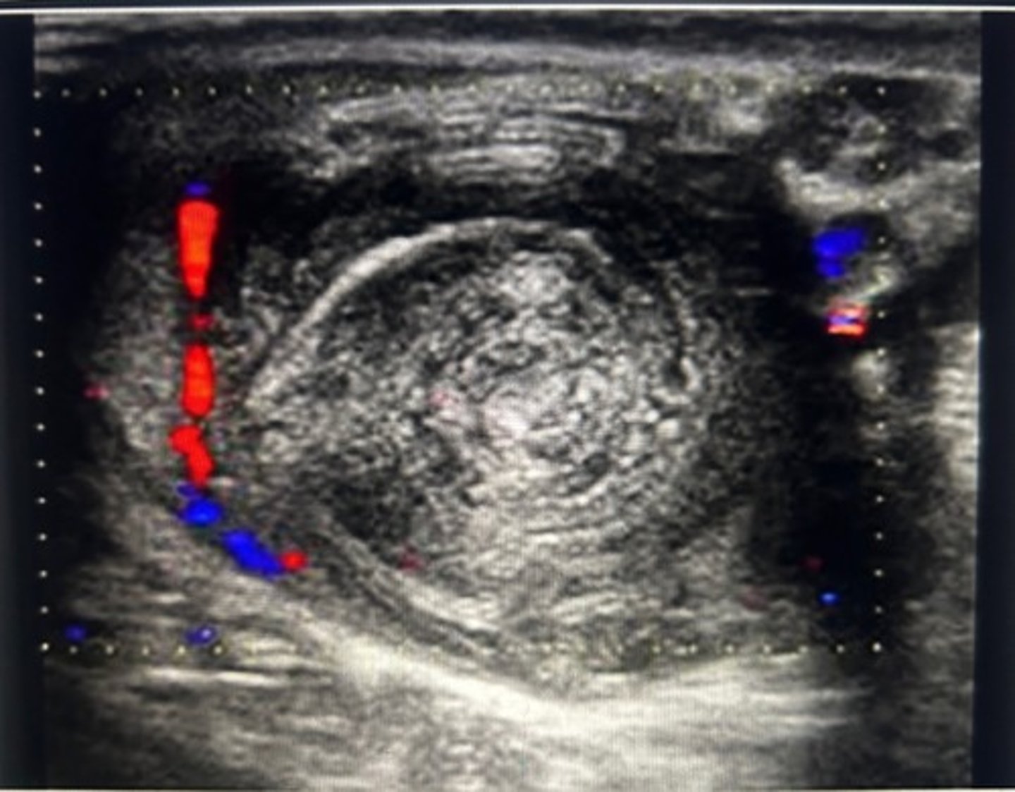<p>Epidermoid cyst</p><p>Note, the rings, have alternating hyperechoic and hypoechoic tissue, giving the mass an onion appearance. Also know that the mass is a vascular. The normal lab values confirm the diagnosis of an epidermoid cyst.</p>