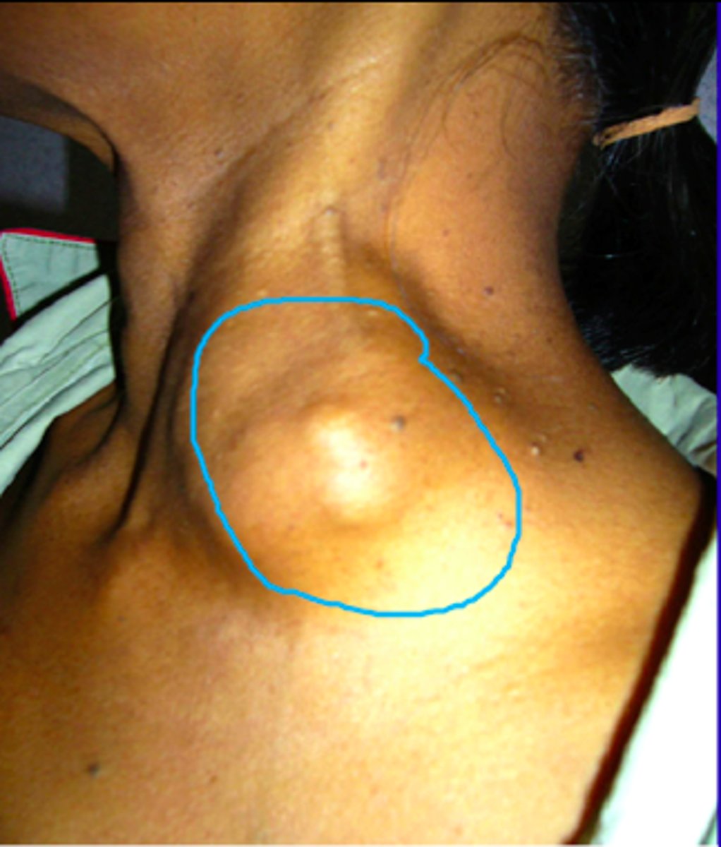 <p>- infection outside the lungs</p><p>- active infection goes untreated or hematogenous spread</p>