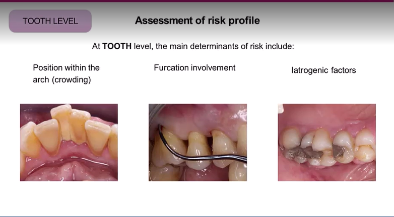 <ol><li><p>Crowding - plaque retentive factor</p></li><li><p>Furcation - applies only to multirooted teeth</p></li><li><p>Iatrogenic factors - overhanging fillings/prothesis</p></li><li><p>residual periodontal support&nbsp;</p></li><li><p>mobility (hypermobility and flaring)</p></li></ol><p></p>