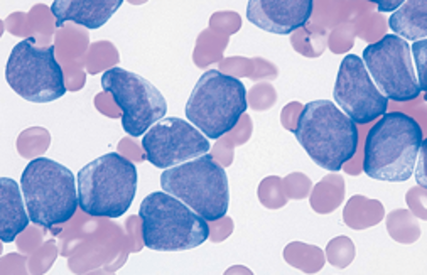 <p>Acute or Chronic Leukemia?</p>